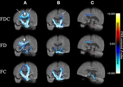 Fixel-Based Analysis of White Matter Degeneration in Patients With Progressive Supranuclear Palsy or Multiple System Atrophy, as Compared to Parkinson's Disease